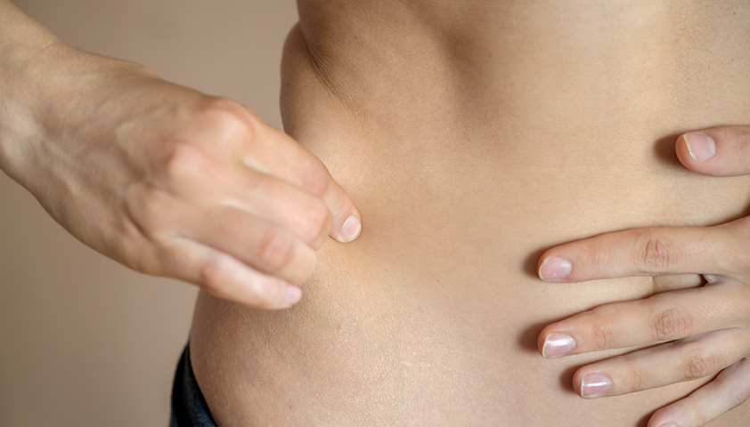 Липодистрофия