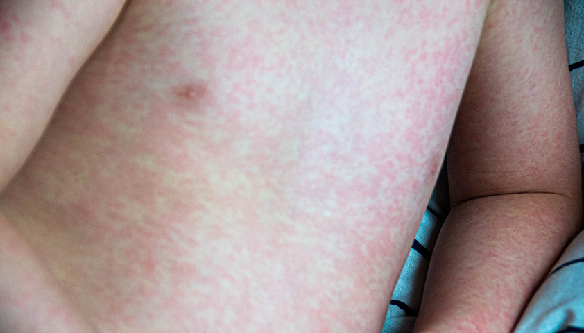 Розеола у детей