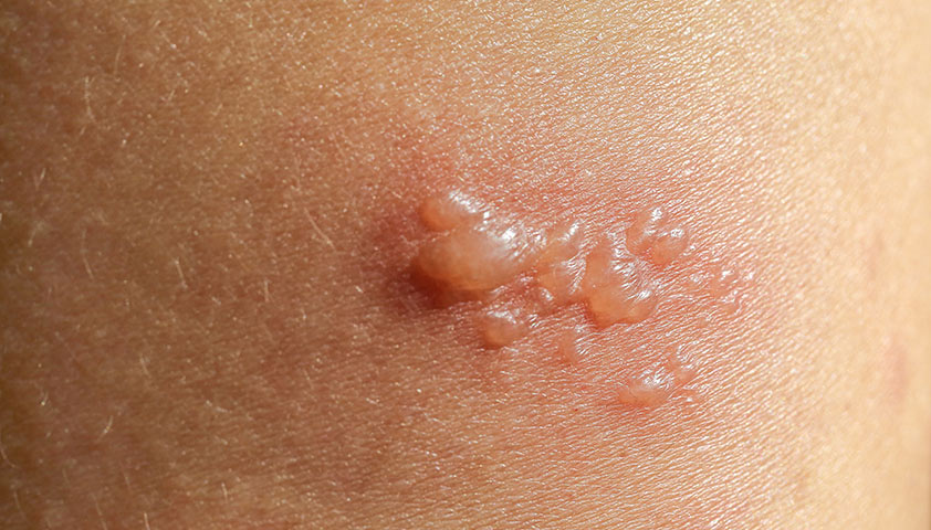 Буллёзный пемфигоид