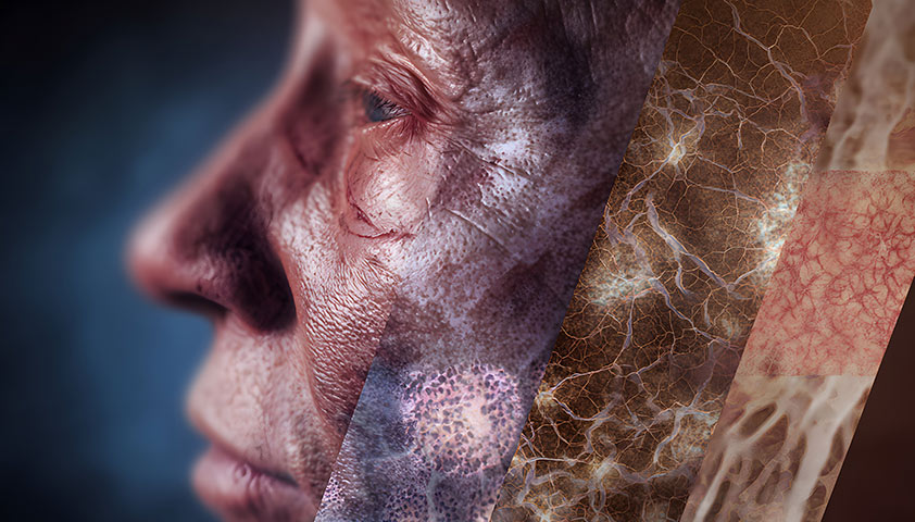 Проказа (Лепра)