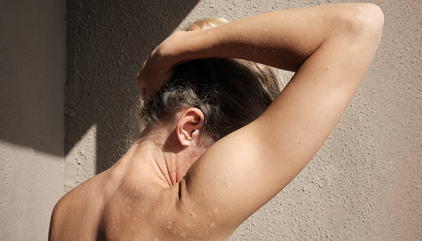 Лечение псориаза