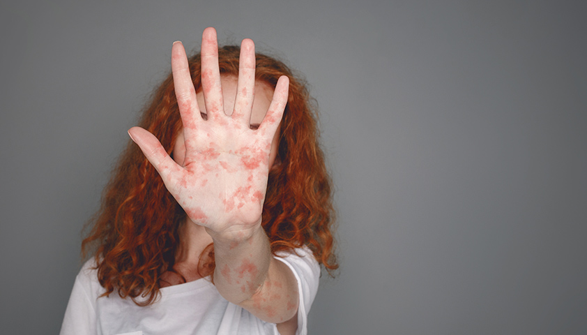 Гиперкератоз кожи — что это, фото, симптомы и лечение