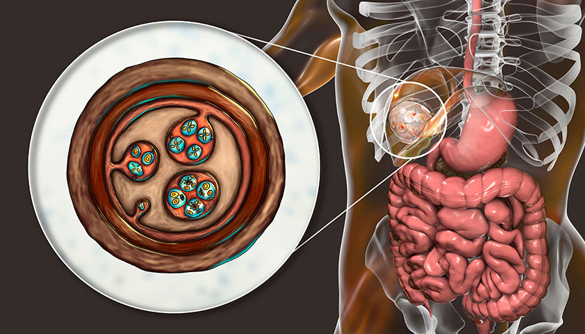 Эхинококкоз