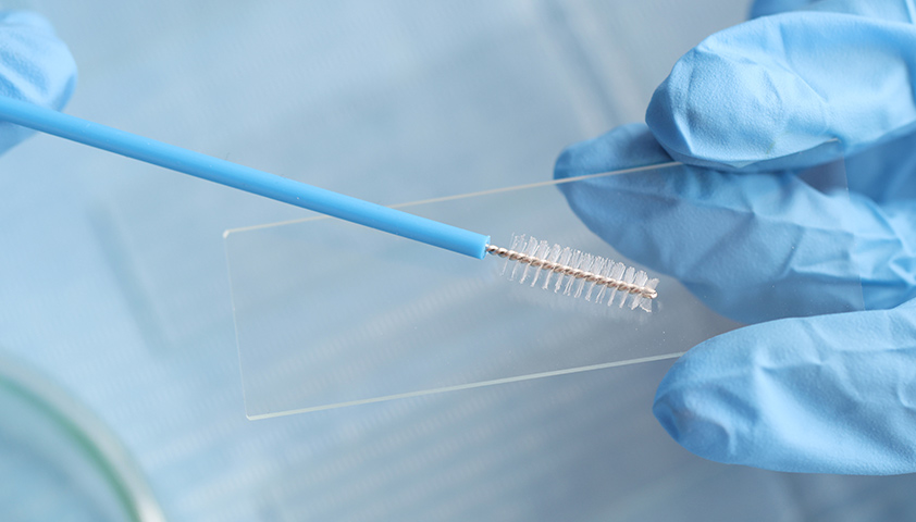 Преимущества и особенности жидкостной цитологии при исследовании соскобов шейки матки