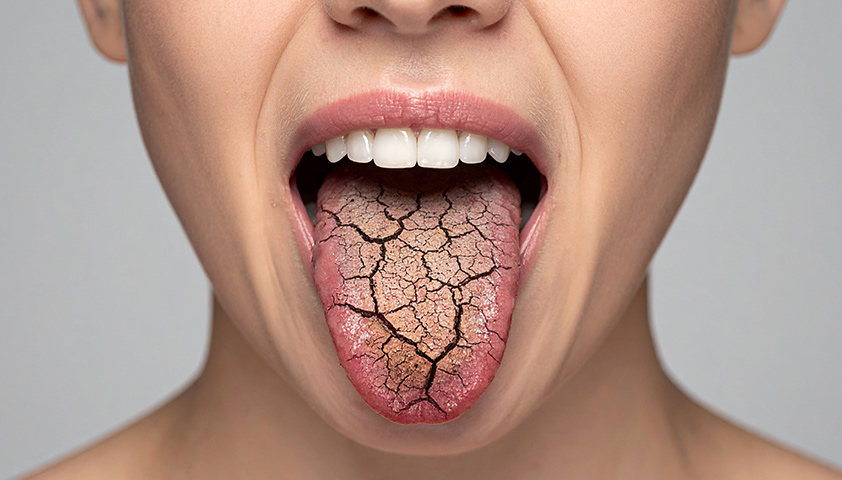 Сухость во рту