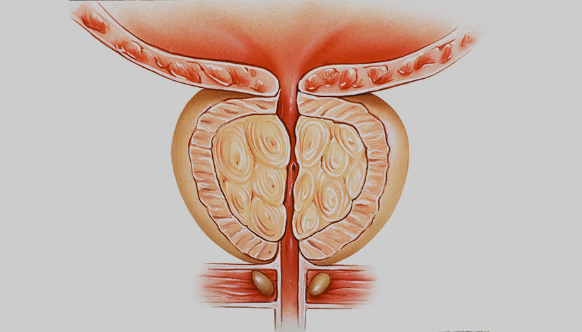 Гиперплазия предстательной железы (увеличенная простата)