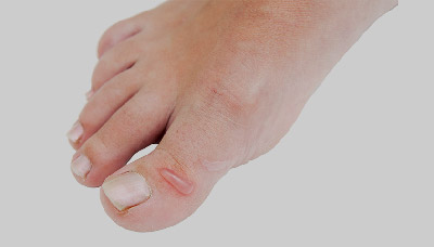 Мягкая мозоль на пальце ноги