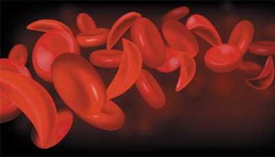 Серповидноклеточная-анемия