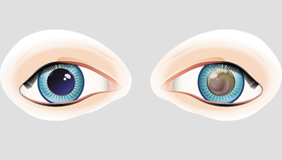 Здоровый-глаз-и-глаз-с-лейкокорией