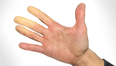 Почему немеют пальцы на руках - причины, онемение левой и правой руки