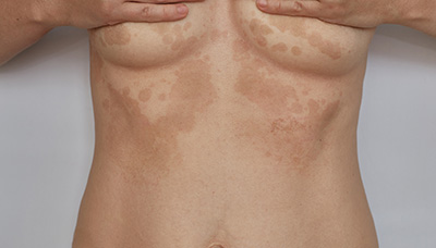 Гиперпигментация кожи шеи: причины и решение