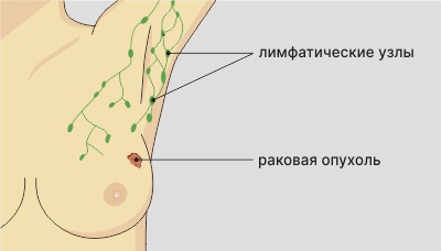 Лимфоузлы под мышками расположение схема у женщин воспаление симптомы