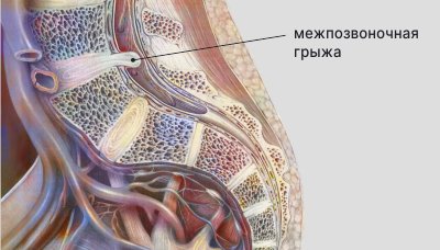 Боли в спине, что покажет МРТ и КТ диагностика? - natali-fashion.ru