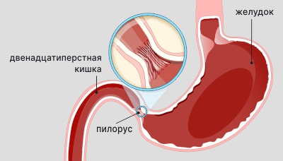 Кровь в стуле при гастрите