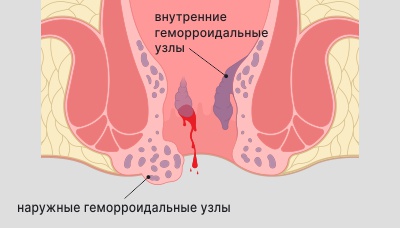 Какой врач лечит геморрой у женщин как называется