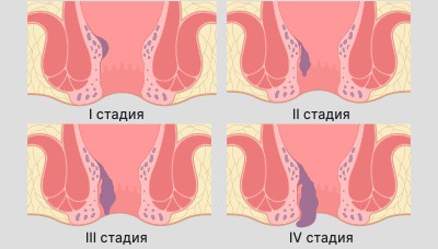 Стадии-геморроя