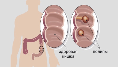 Полипы