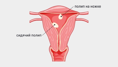 Полип эндометрия (полип матки)
