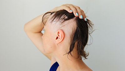 Выпадения волос (алопеция) у женщин и мужчин - причины, что делать
