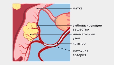 Эмболизация миомы