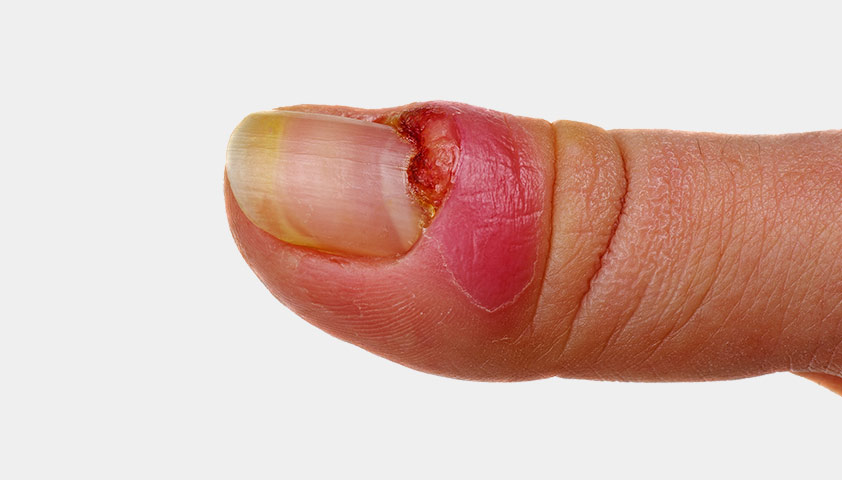 Панариций на пальце: как избавиться от воспаления