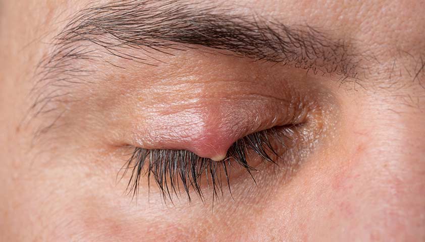 Ячмень на глазу: как быстро вылечить, причины появления, симптомы и профилактика глазного ячменя