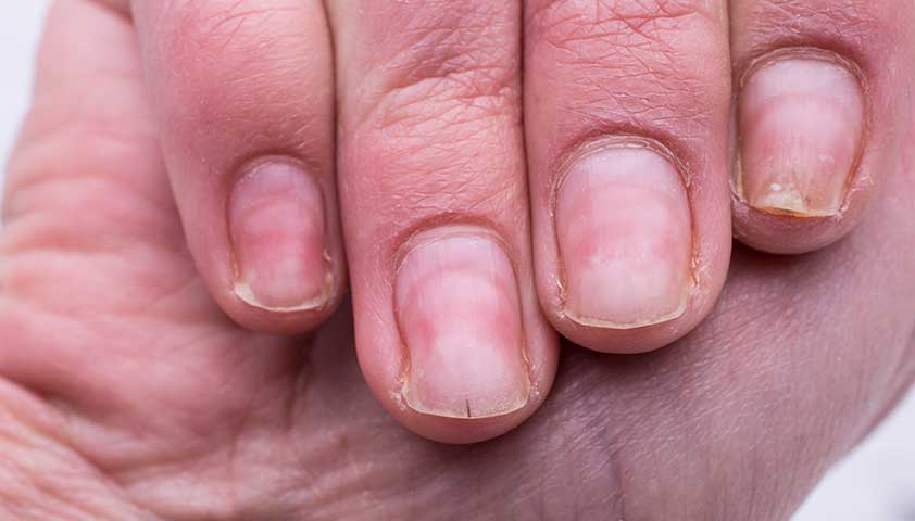 Причины слоящихся ногтей