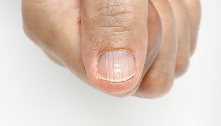 О чем говорят ногти? Из-за чего возникают бороздки, вмятины и пятна на ногтях?