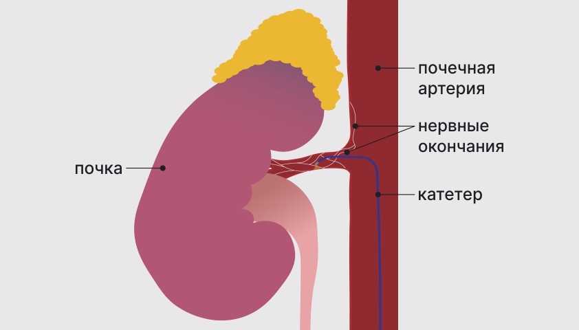 Какая связь существует между артериальной гипертонией и заболеванием почек?
