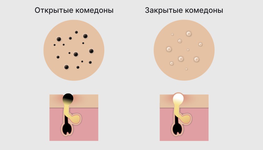 Лечение закрытых комедонов: эффективность косметических средств и аппаратных методик