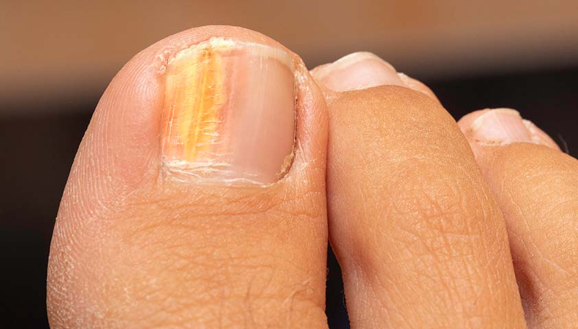 Как избавиться от грибка ногтей на руках и ногах — блог клиники Platinum Laser