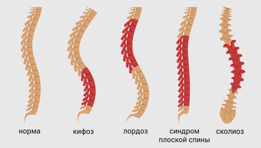 Дорсопатия грудного отдела позвоночника