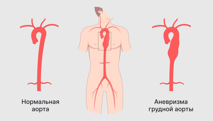 Для болезни такаясу характерно наличие в клинической картине