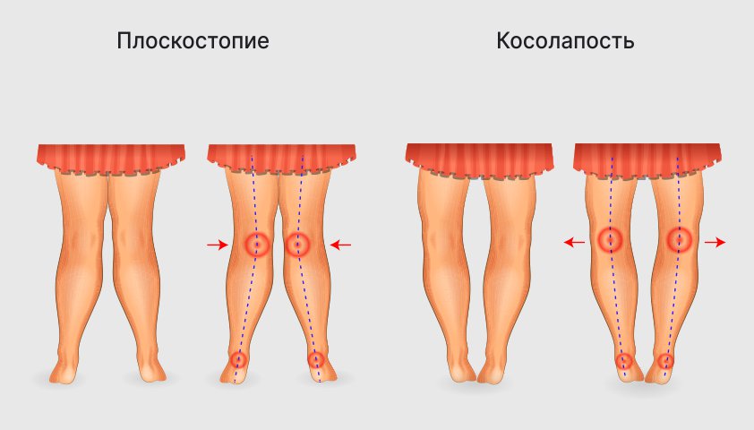 Может ли болеть колено из-за плоскостопия?