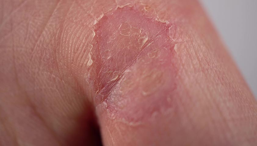 Почему лопается кожа на пальцах: причины и способы предотвращения