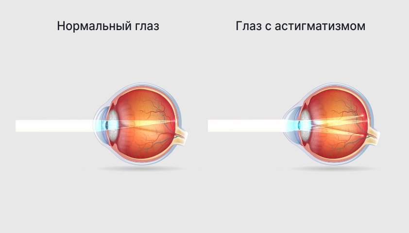 Лазерная коррекция зрения при астигматизме