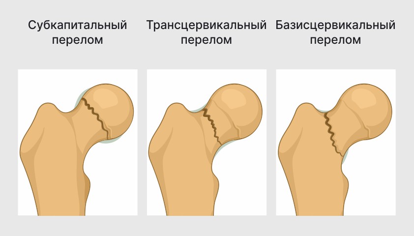 Перелом шейки бедра симптомы