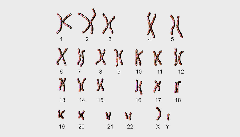 Сколько хромосом у человека с синдромом Дауна?