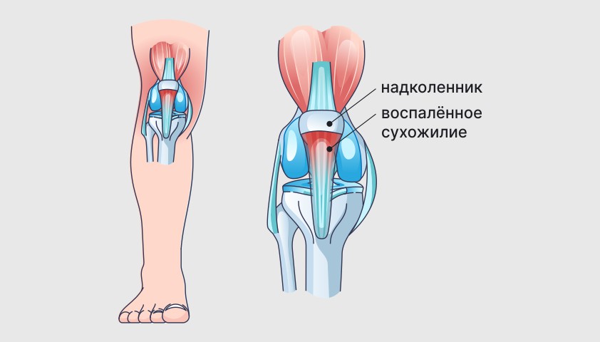 Латерализация надколенника.