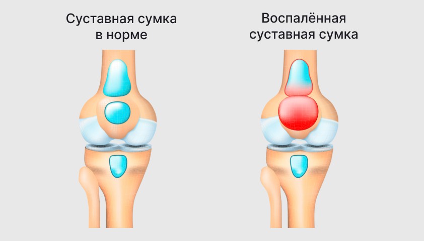 Воспаление коленного сустава: симптомы, диагностика, лечение суставов колена