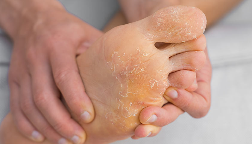 Пузырится и шелушится: почему облезает кожа с пальцев рук и ног