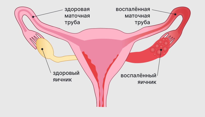 Воспаление матки у женщин симптомы и лечение. Воспаление маточных труб. Воспаленная шейка матки. Хроническое воспаление матки.