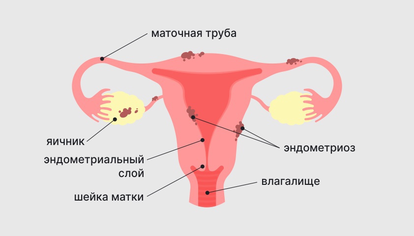 Эндометриоз – лечение в Москве в клинике доктора Назимовой
