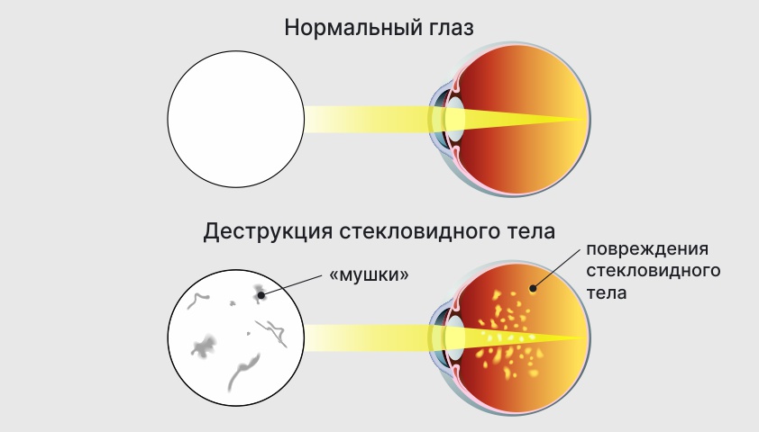 Витреолизис. Дестркуция стекловидногт ела. Деструкция глазного яблока. Плавающие помутнения в глазах.