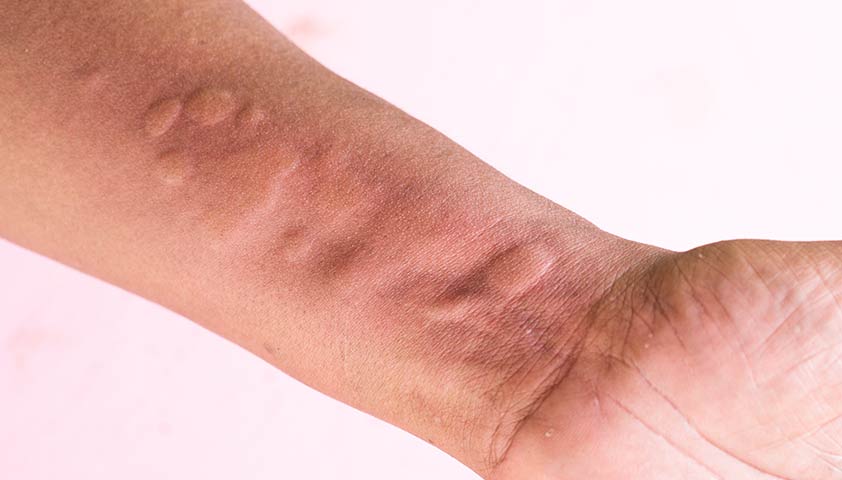 Аллергии - симптомы и признаки, виды, что делать при аллергии