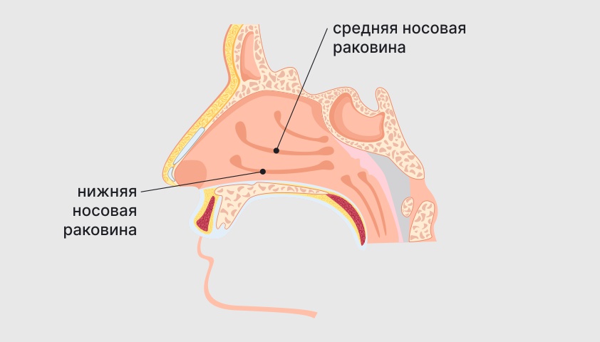 Хронический ринит (вазомоторный, гипертрофический, катаральный). Лечение заложенного носа.