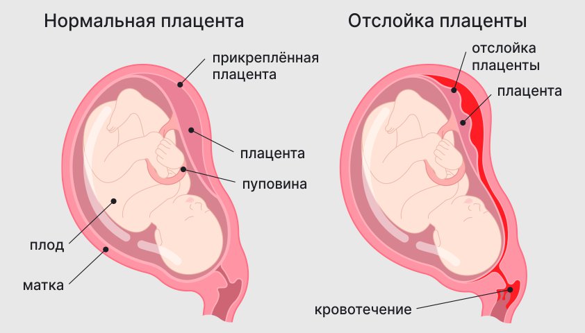 Кровотечение при беременности