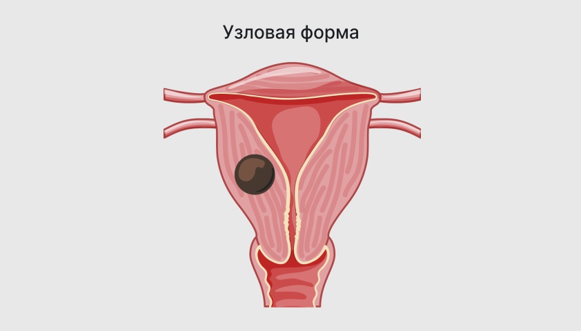 Аденомиоз матки симптомы и лечение | Признаки диффузной формы аденомиоза у женщин