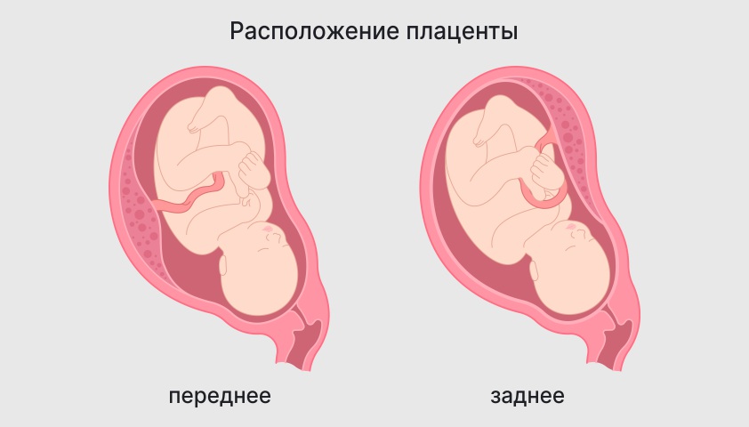 Низкое расположение плаценты при беременности