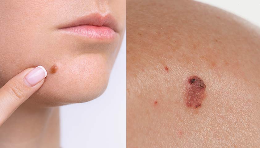 Рак кожи - симптомы, признаки, как выглядит и проявляется
